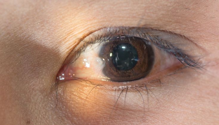 Raspagem no olho não é catarata: entenda o que é pterígio
