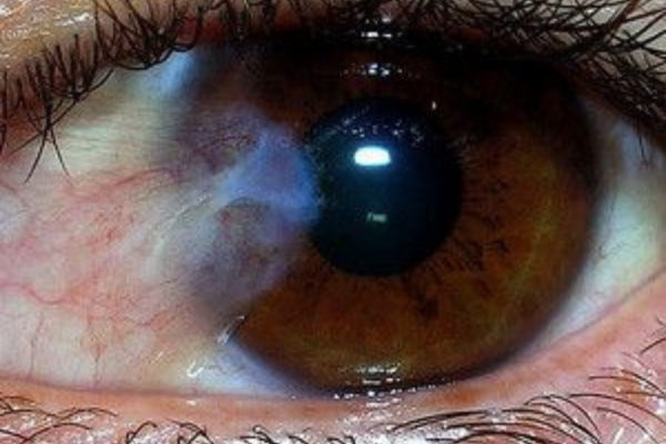 Raspagem no olho não é catarata: entenda o que é pterígio