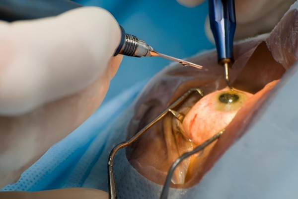 O que você precisa saber sobre a cirurgia de catarata